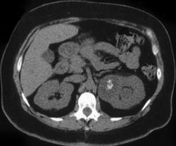 Focal Xanthogranulomatous Pyelonephritis (XGP) - CTisus CT Scan