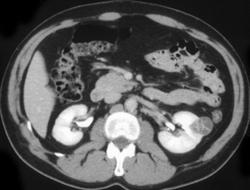 Hypervascular Renal Cell Carcinoma - CTisus CT Scan