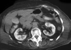 Acute tubular necrosis (ATN) Secondary to Angiogram - CTisus CT Scan