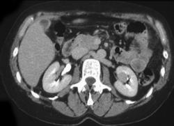 Small Hypervascular Renal Cell Carcinoma - CTisus CT Scan