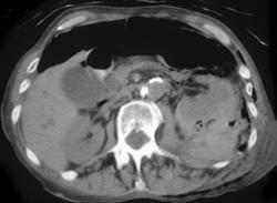 Perirenal Bleed Following Renal Biopsy - CTisus CT Scan