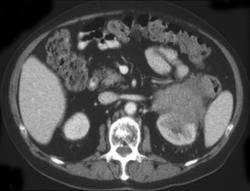 Renal Lymphoma - CTisus CT Scan