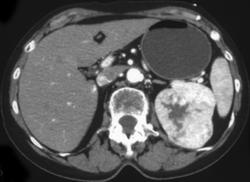 Renal Cell Carcinoma - CTisus CT Scan