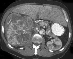 Renal Cell Carcinoma - CTisus CT Scan