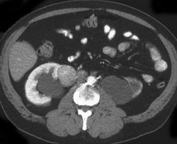 Teratoma Adjacent to Right Kidney Causing Hydronephrosis - CTisus CT Scan