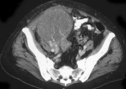 Rejected Renal Transplant - CTisus CT Scan