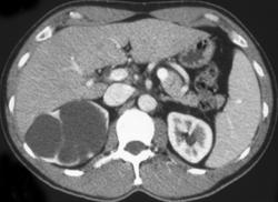 Multilocular Cystic Nephroma - CTisus CT Scan
