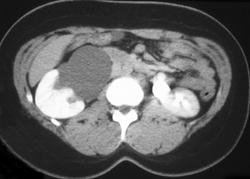 Dilated Extrarenal Pelvis - CTisus CT Scan