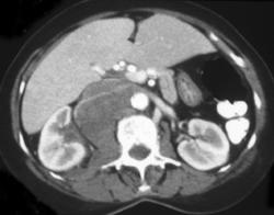 Lung Cancer Metastatic to Renal Hilum - CTisus CT Scan