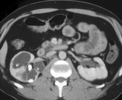 Renal Calculi With Dilated Calyces - CTisus CT Scan