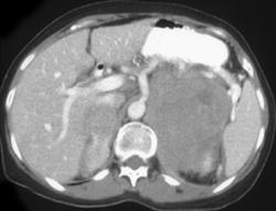 Adrenal and Renal Lymphoma - CTisus CT Scan