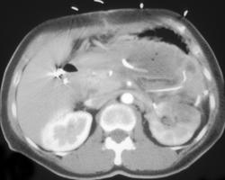 Infarcted Left Kidney - CTisus CT Scan