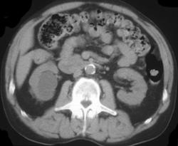 Renal Cyst - CTisus CT Scan