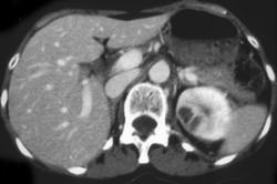 Renal Abscess - CTisus CT Scan