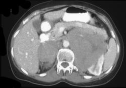 Renal and Adrenal Lymphoma - CTisus CT Scan
