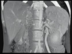 Large Left Gonadal Vein - CTisus CT Scan