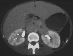 Pyelonephritis - CTisus CT Scan