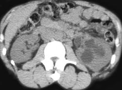 Left Hydronephrosis - CTisus CT Scan