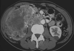 Renal Cell Carcinoma With Lymphangitic Spread in the Lungs - CTisus CT Scan