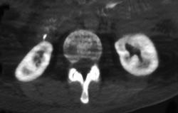 Oxalosis (non-contrast Study) - CTisus CT Scan