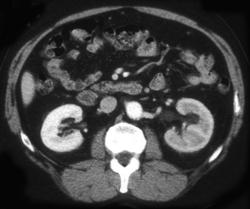 Delayed Left Renal Function - CTisus CT Scan