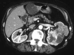 Renal Cell Carcinoma - CTisus CT Scan