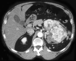 Renal Cell Carcinoma - CTisus CT Scan