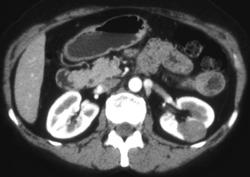 Renal Cell Carcinoma - CTisus CT Scan