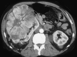 Oncocytoma - CTisus CT Scan