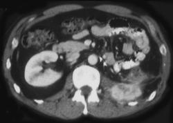 Recurrent Renal Cell in Nephrectomy Bed - CTisus CT Scan