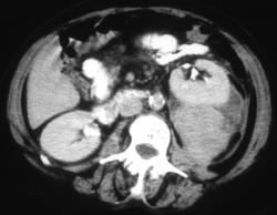 Perirenal Bleed Due to A Renal Carcinoma - CTisus CT Scan