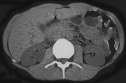 Right Extrarenal Pelvis - CTisus CT Scan