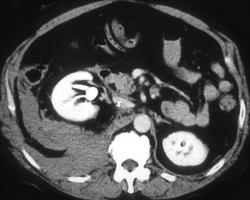 Bleed Into Posterior Pararenal Space - CTisus CT Scan