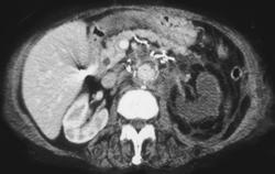 Infarcted Left Kidney Post Aneurysm Repair Surgery - CTisus CT Scan