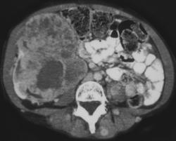Renal Sarcoma - CTisus CT Scan