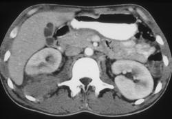 Renal Laceration With Bleed - CTisus CT Scan