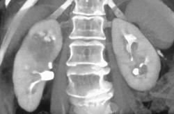 Transitional Cell Carcinoma - CTisus CT Scan