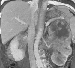 Renal Cell Carcinoma Invading the Perivascular Space - CTisus CT Scan