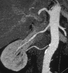 Calcification Near the Origin of the Lower Pole Renal Artery - CTisus CT Scan