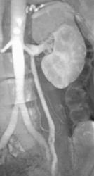 Normal Left Ovarian Vein - CTisus CT Scan