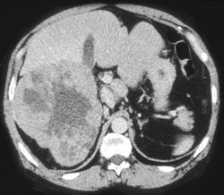 Renal Carcinoma - CTisus CT Scan