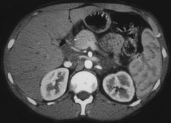 Adrenal Lymphoma - CTisus CT Scan