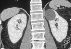 Bosniak I Renal Cyst - CTisus CT Scan