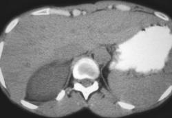 Fluid Around Kidney Is Usually Seen With Inflammation - CTisus CT Scan