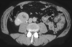 Renal Cell Carcinoma - CTisus CT Scan