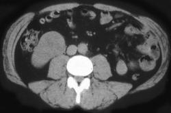 Renal Cell Carcinoma - CTisus CT Scan
