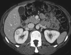 Oncocytoma - CTisus CT Scan
