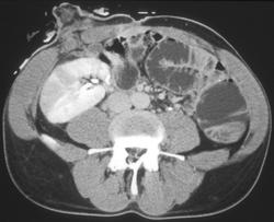 Acute Pyelonephritis - CTisus CT Scan