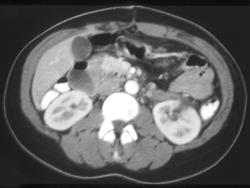 Renal Laceration - CTisus CT Scan