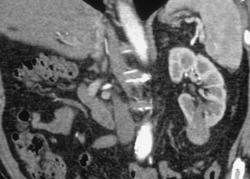 Left Renal Cell Carcinoma - CTisus CT Scan